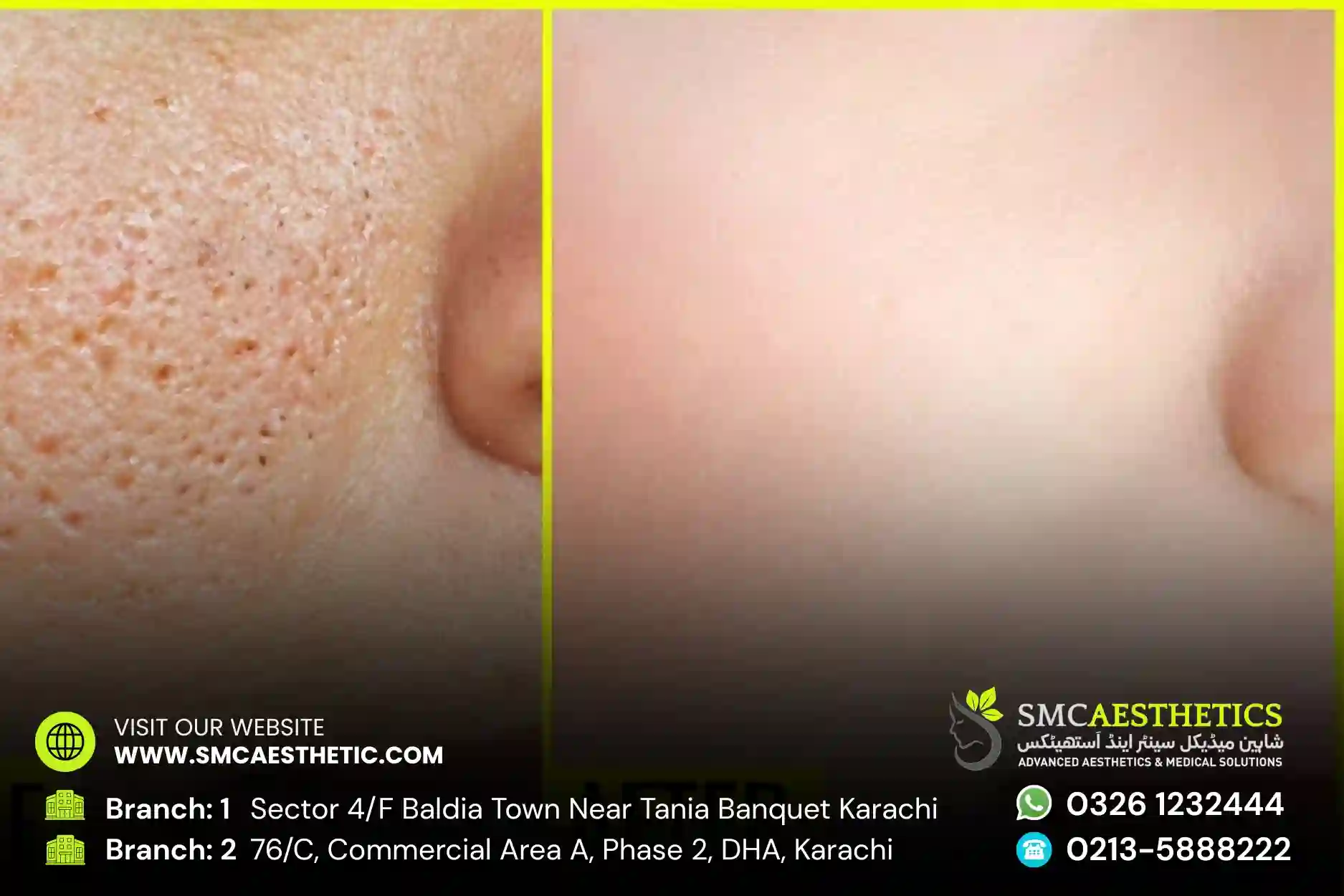 Open Pores Treatment in Karachi - Skin Texture Refinement at SMC Aesthetics